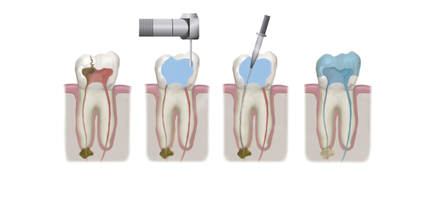 Endodoncia - Clínica Larratxo - Larratxo Hortz klinika