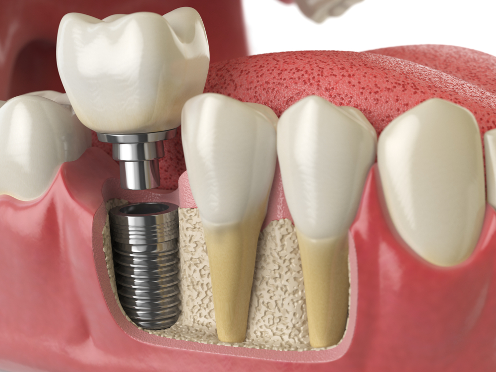 Implantología - clínica dental larratxo - larratxo hortz klinika