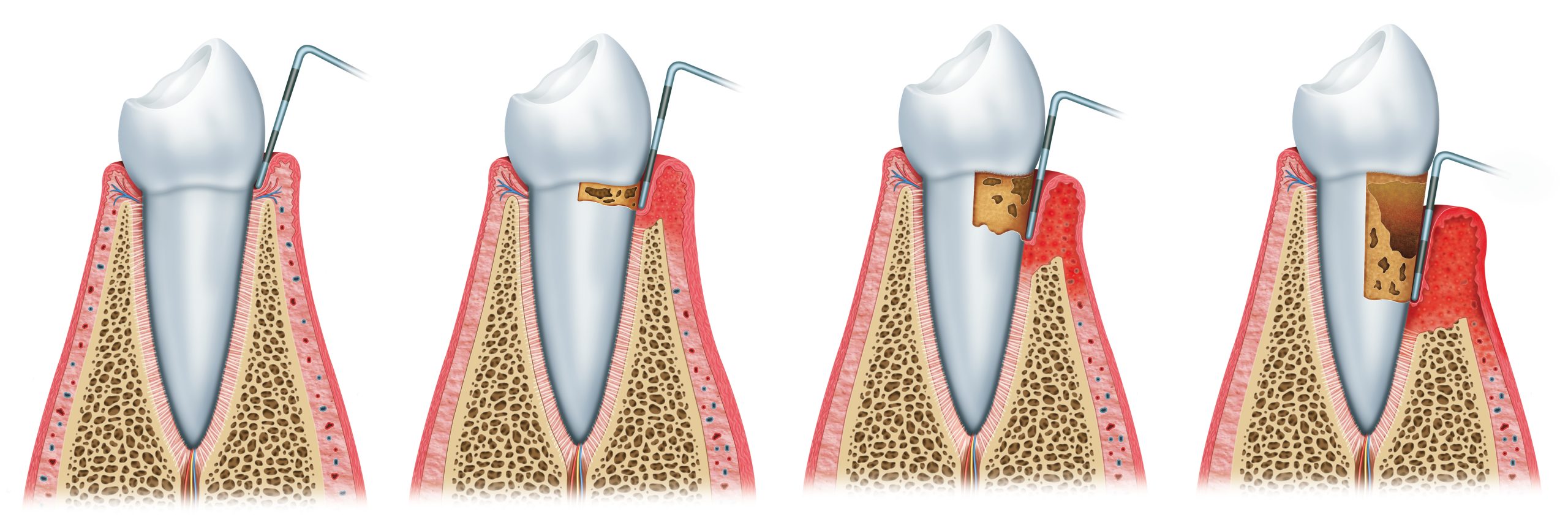 Periodoncia - clínica dental larratxo - larratxo hotz klinika