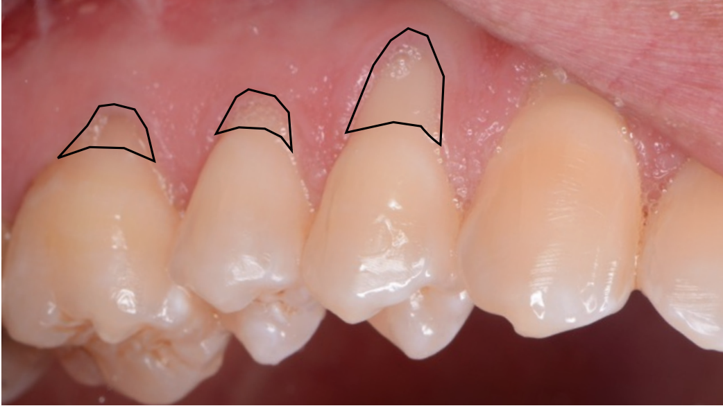 Periodoncia - clínica dental larratxo - larratxo hotz klinika